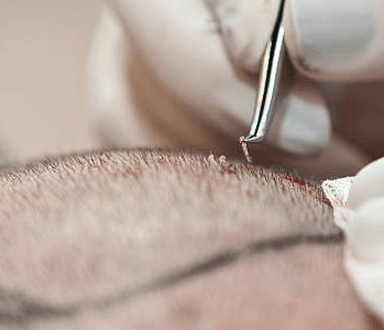 hair transplant cost