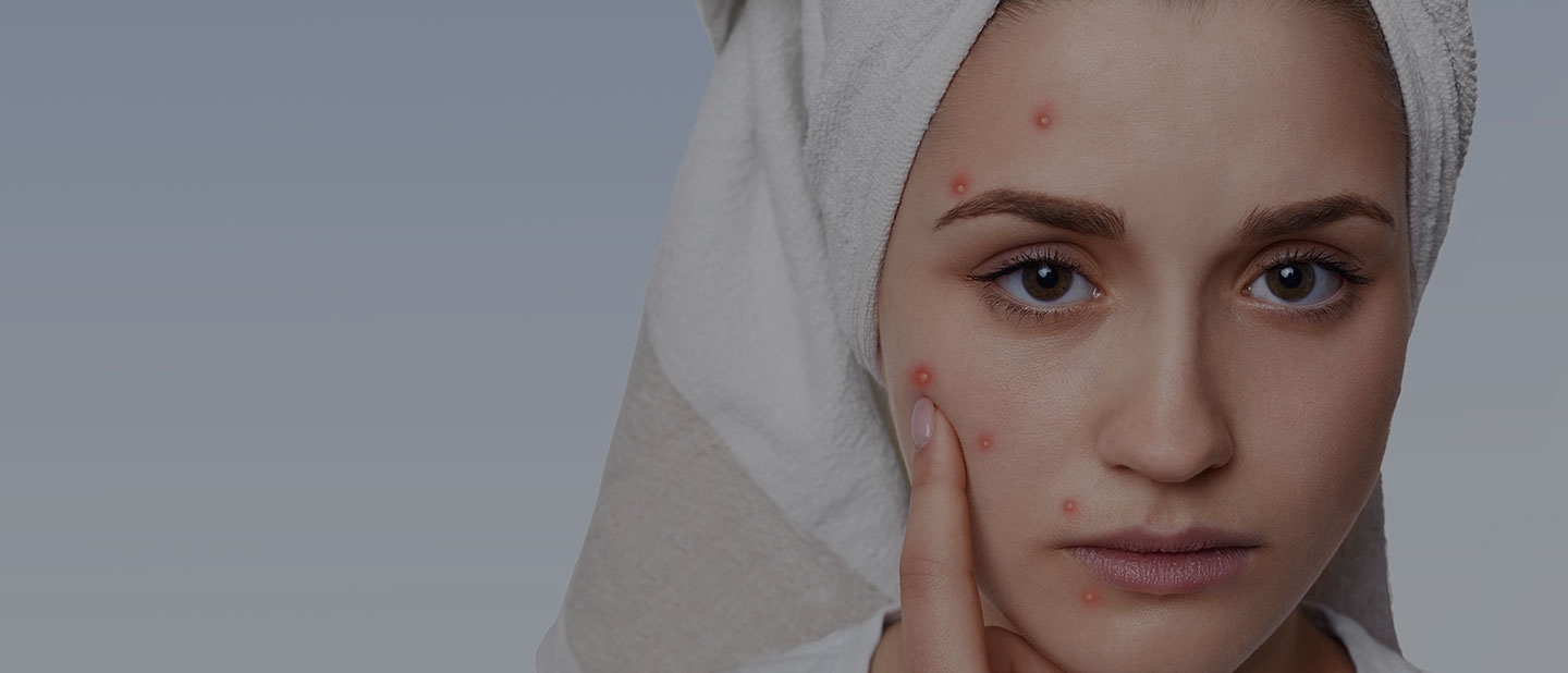 Acne Treatment in Delhi: Causes, Symptoms, and Treatment Options