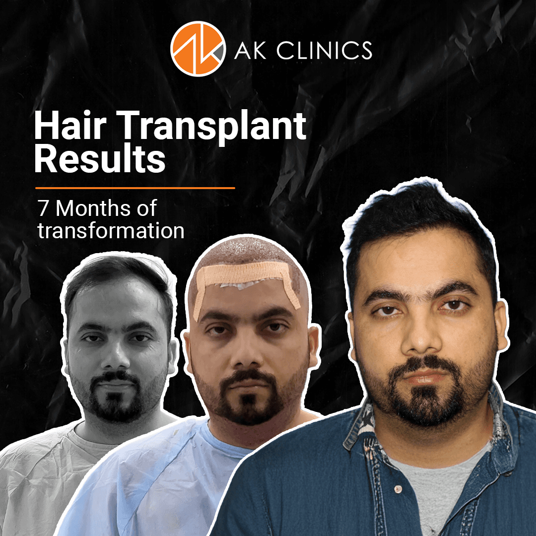 hair transplant cost in delhi