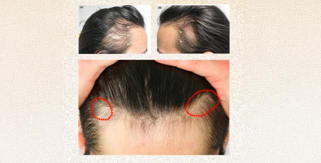 Female Hair Transplant: Traction Alopecia Treated with 1500 Grafts Using BIO-FUE™