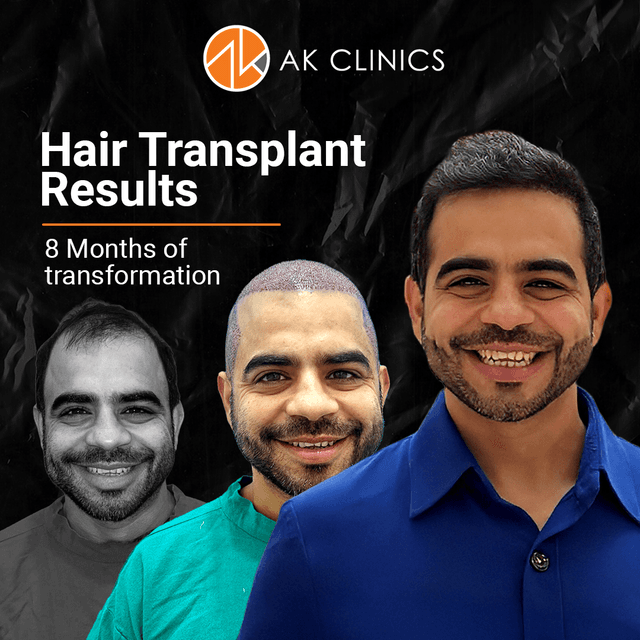 Hair Transplant Cost in Delhi