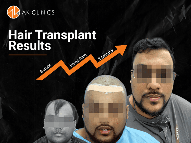 Hair Transplant Cost in Punjab (2026): A Clear Guide to Grafts, Techniques & Medical Planning