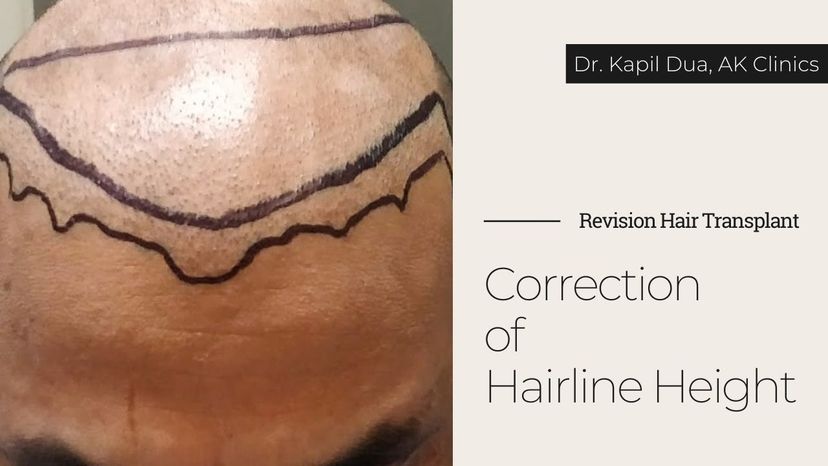 Hairline Correction in Patient | Hairline reconstruction surgery | Dr Kapil dua