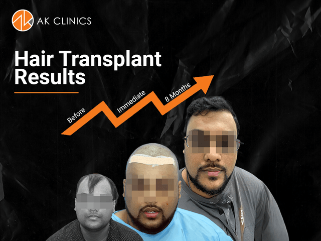 hair transplant cost chandigarh