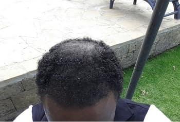 Curly Hair Patient Success Story