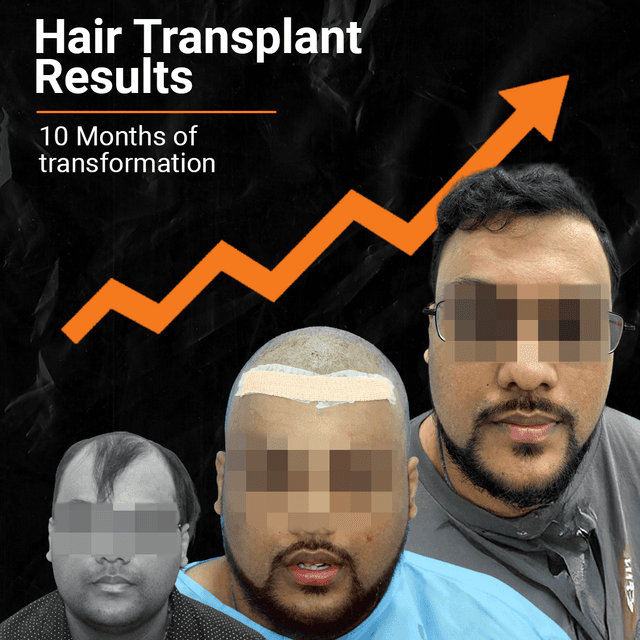Hair Transplant Cost in Chandigarh (2026): Graft-Wise Pricing & Techniques